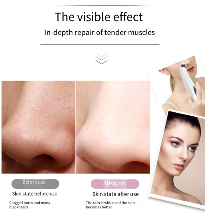 Pore Vacuum Blackhead Remover – USA Fast Shipping, 3 Speeds + 3 Heads